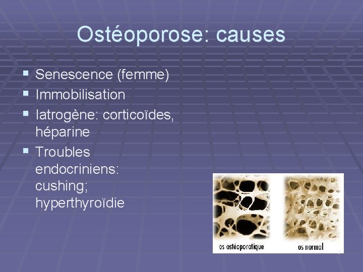 Ostéoporose: causes § Senescence (femme) § Immobilisation § Iatrogène: corticoïdes, héparine § Troubles endocriniens: