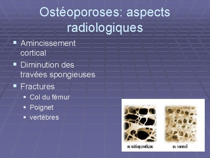 Ostéoporoses: aspects radiologiques § Amincissement cortical § Diminution des travées spongieuses § Fractures §