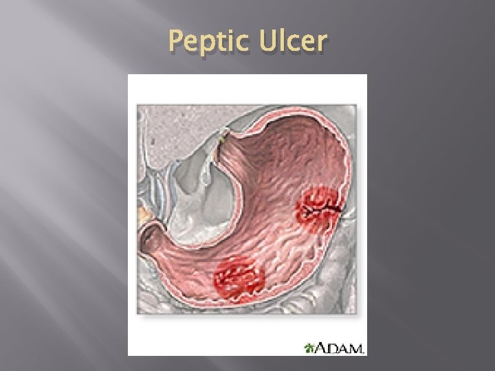Peptic Ulcer Peptic Ulcer