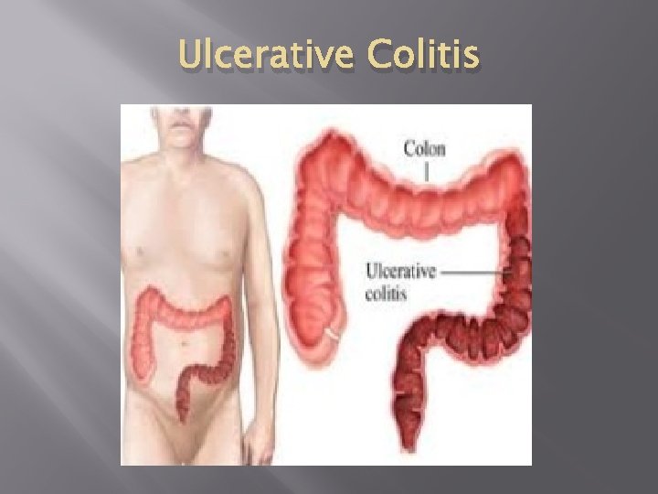 Ulcerative Colitis Ulcerative Colitis