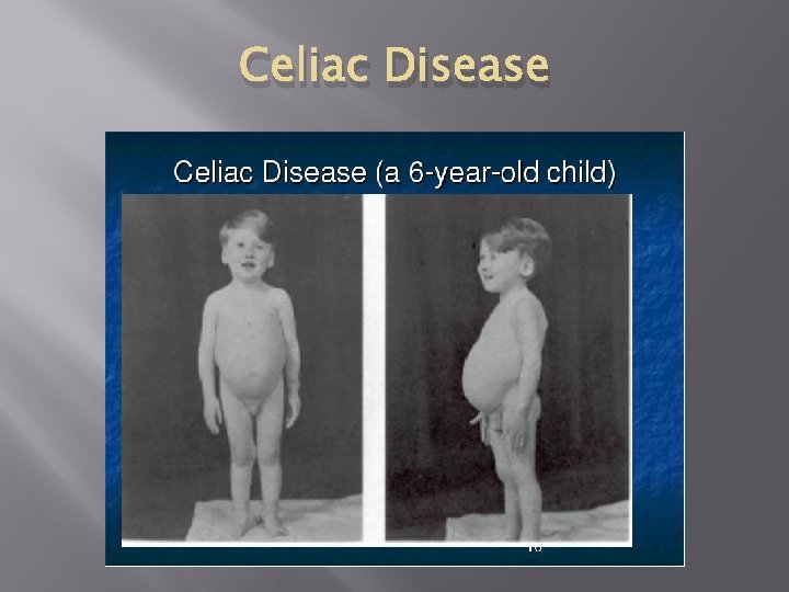 Celiac Disease Celiac Disease