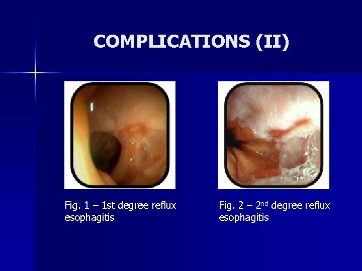 COMPLICATIONS (II) Fig. 1 – 1 st degree reflux esophagitis Fig. 2 – 2