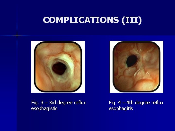 COMPLICATIONS (III) Fig. 3 – 3 rd degree reflux esophagistis Fig. 4 – 4