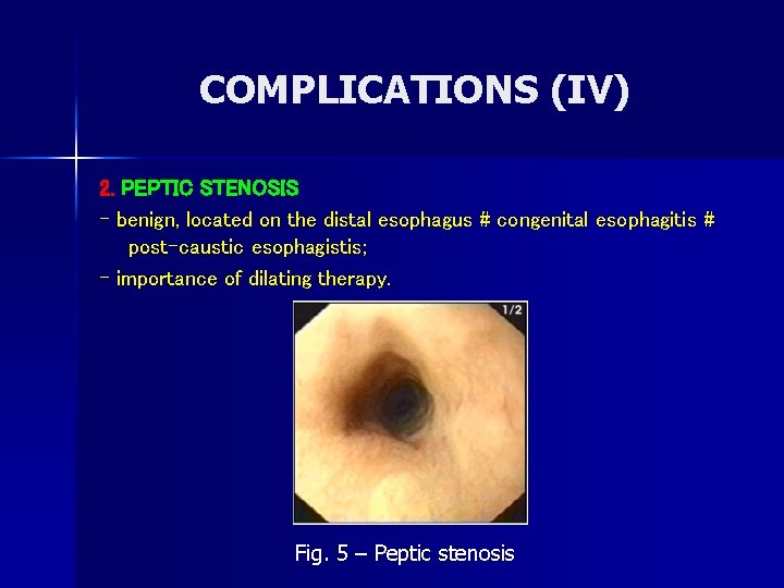COMPLICATIONS (IV) 2. PEPTIC STENOSIS - benign, located on the distal esophagus # congenital