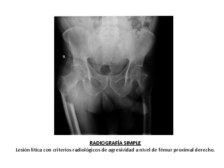 RADIOGRAFÍA SIMPLE Lesión lítica con criterios radiológicos de agresividad a nivel de fémur proximal