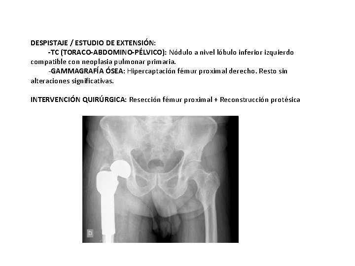 DESPISTAJE / ESTUDIO DE EXTENSIÓN: -TC (TORACO-ABDOMINO-PÉLVICO): Nódulo a nivel lóbulo inferior izquierdo compatible