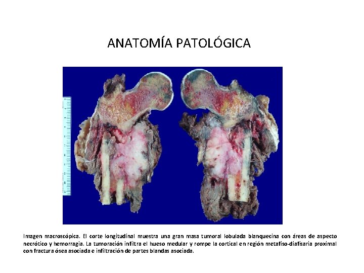 ANATOMÍA PATOLÓGICA Imagen macroscópica. El corte longitudinal muestra una gran masa tumoral lobulada blanquecina