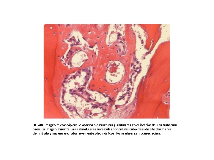 HE x 40. Imagen microscópica: Se observan estructuras glandulares en el interior de una