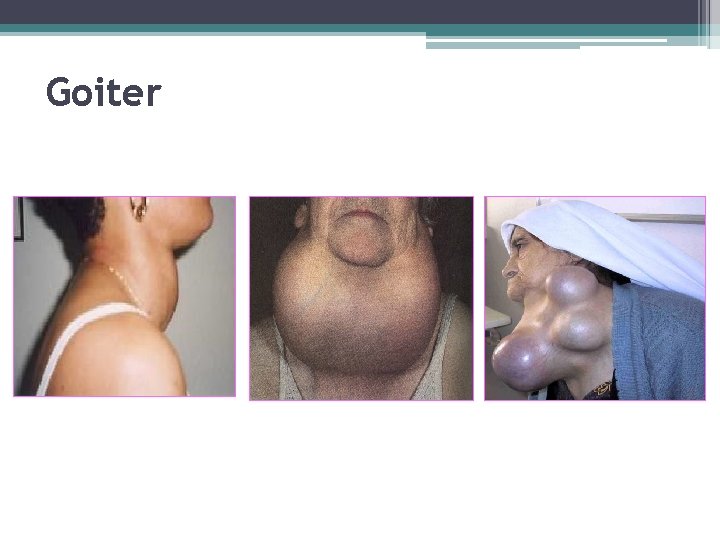 Goiter 