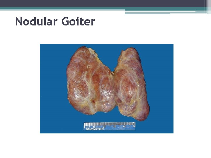 Nodular Goiter 