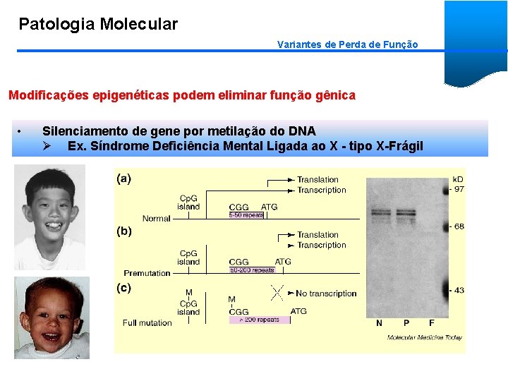 Patologia Molecular Variantes de Perda de Função Modificações epigenéticas podem eliminar função gênica •