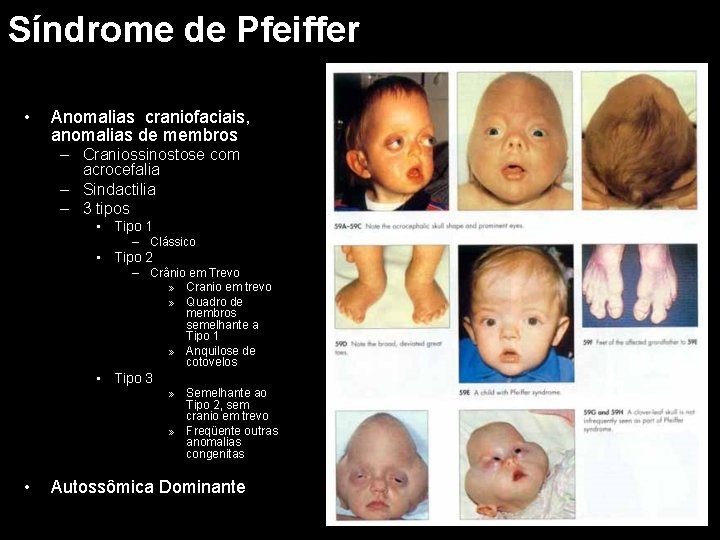 Síndrome de Pfeiffer • Anomalias craniofaciais, anomalias de membros – Craniossinostose com acrocefalia –