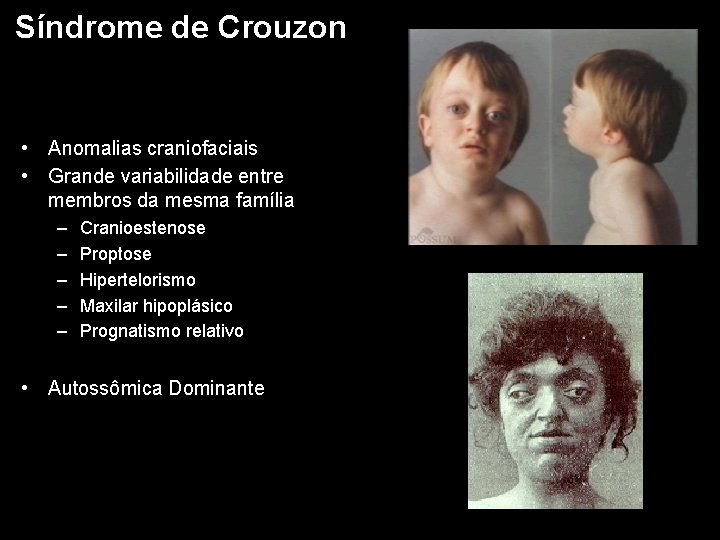 Síndrome de Crouzon • Anomalias craniofaciais • Grande variabilidade entre membros da mesma família