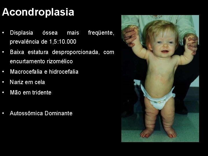 Acondroplasia • Displasia óssea mais freqüente, prevalência de 1, 5: 10. 000 • Baixa