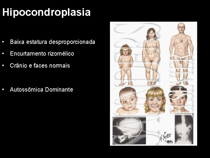 Hipocondroplasia • Baixa estatura desproporcionada • Encurtamento rizomélico • Crânio e faces normais •