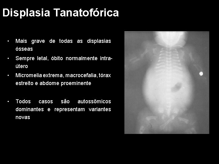 Displasia Tanatofórica • Mais grave de todas as displasias ósseas • Sempre letal, óbito