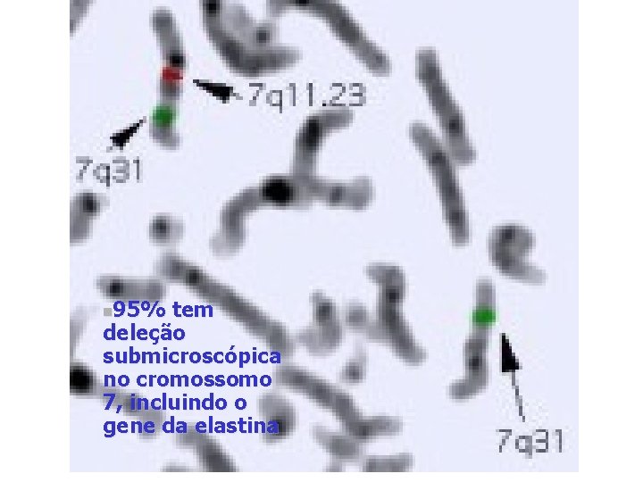 95% tem deleção submicroscópica no cromossomo 7, incluindo o gene da elastina n 