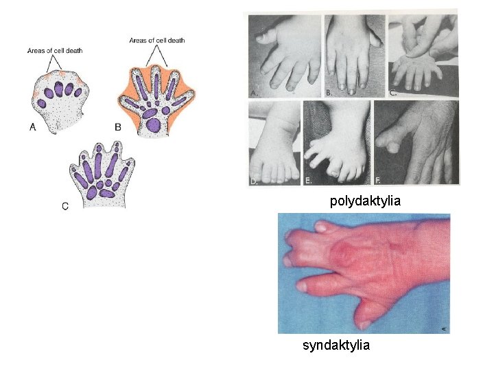 polydaktylia syndaktylia 