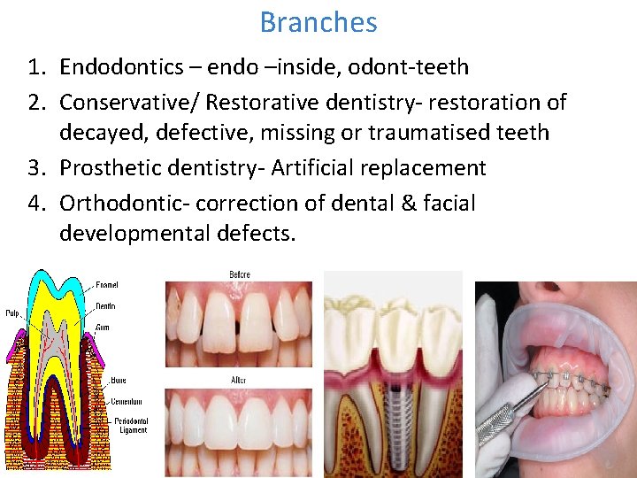 Branches 1. Endodontics – endo –inside, odont-teeth 2. Conservative/ Restorative dentistry- restoration of decayed,