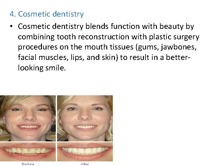 4. Cosmetic dentistry • Cosmetic dentistry blends function with beauty by combining tooth reconstruction