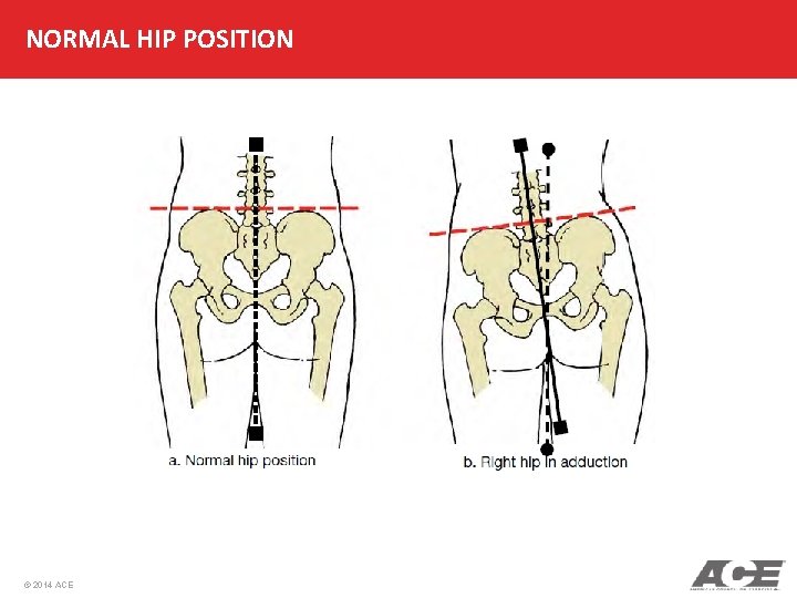 NORMAL HIP POSITION © 2014 ACE 
