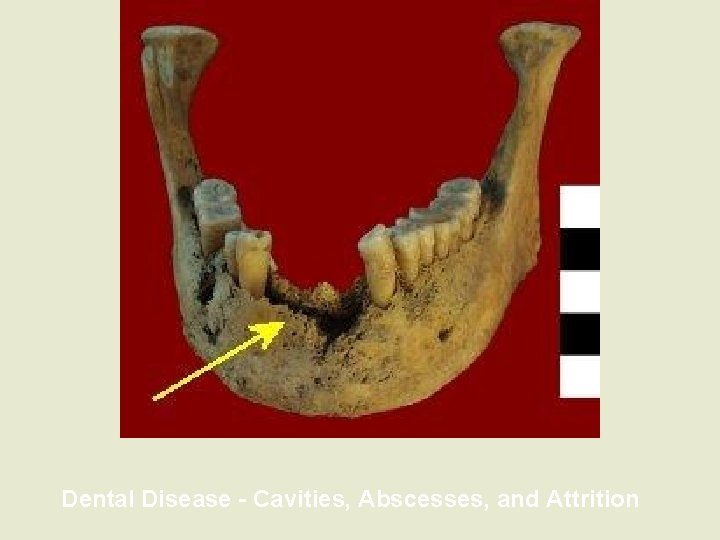 Dental Disease - Cavities, Abscesses, and Attrition 