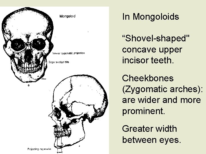 In Mongoloids “Shovel-shaped" concave upper incisor teeth. Cheekbones (Zygomatic arches): are wider and more