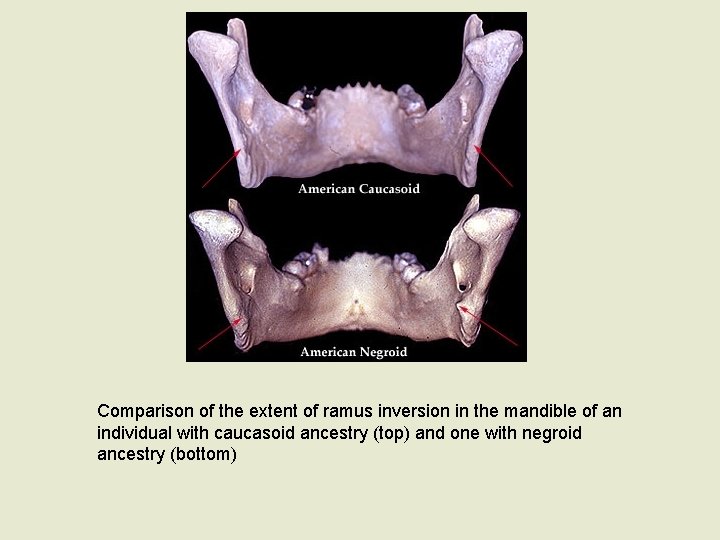 Comparison of the extent of ramus inversion in the mandible of an individual with