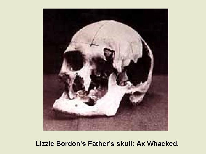 Lizzie Bordon’s Father’s skull: Ax Whacked. 