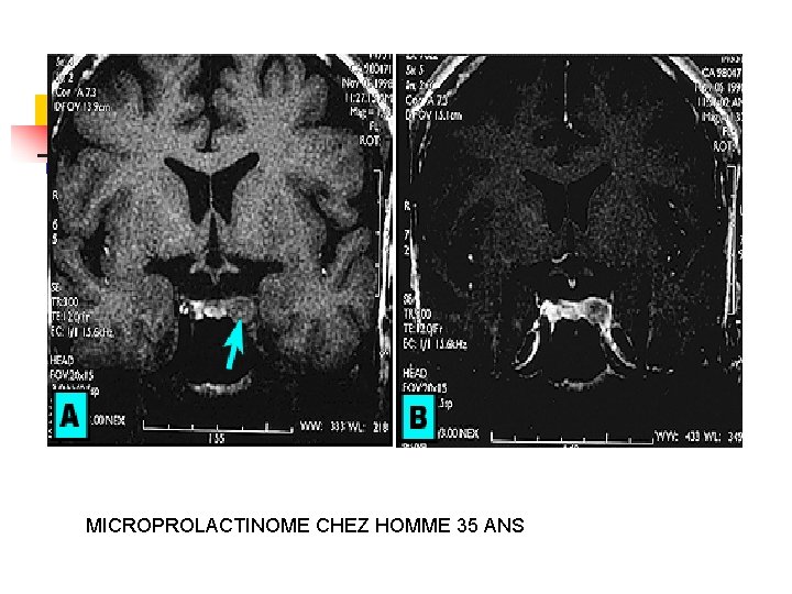 MICROPROLACTINOME CHEZ HOMME 35 ANS MICROPROLACTINOME CHEZ HOMME 35 ANS