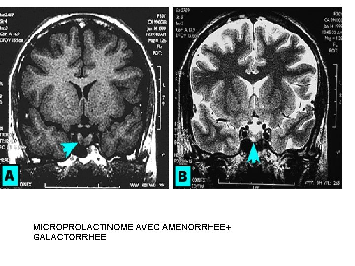 MICROPROLACTINOME AVEC AMENORRHEE+ GALACTORRHEE MICROPROLACTINOME AVEC AMENORRHEE+ GALACTORRHEE