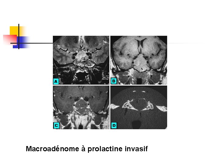 Macroadénome à prolactine invasif Macroadénome à prolactine invasif