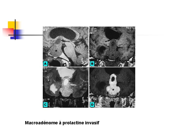 Macroadénome à prolactine invasif Macroadénome à prolactine invasif