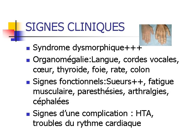 SIGNES CLINIQUES n n Syndrome dysmorphique+++ Organomégalie: Langue, cordes vocales, cœur, thyroide, foie, rate, SIGNES CLINIQUES n n Syndrome dysmorphique+++ Organomégalie: Langue, cordes vocales, cœur, thyroide, foie, rate,
