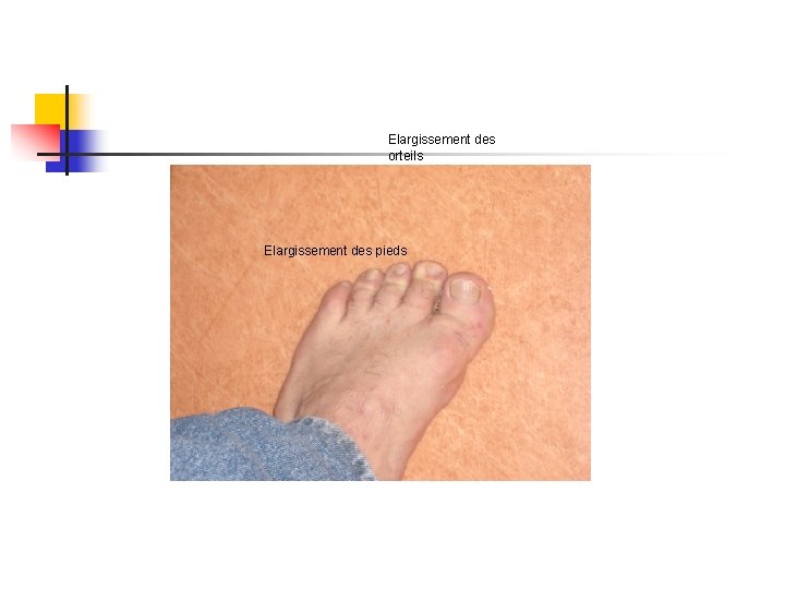 Elargissement des orteils Elargissement des pieds Elargissement des orteils Elargissement des pieds