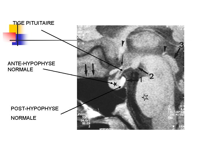 TIGE PITUITAIRE ANTE-HYPOPHYSE NORMALE POST-HYPOPHYSE NORMALE TIGE PITUITAIRE ANTE-HYPOPHYSE NORMALE POST-HYPOPHYSE NORMALE