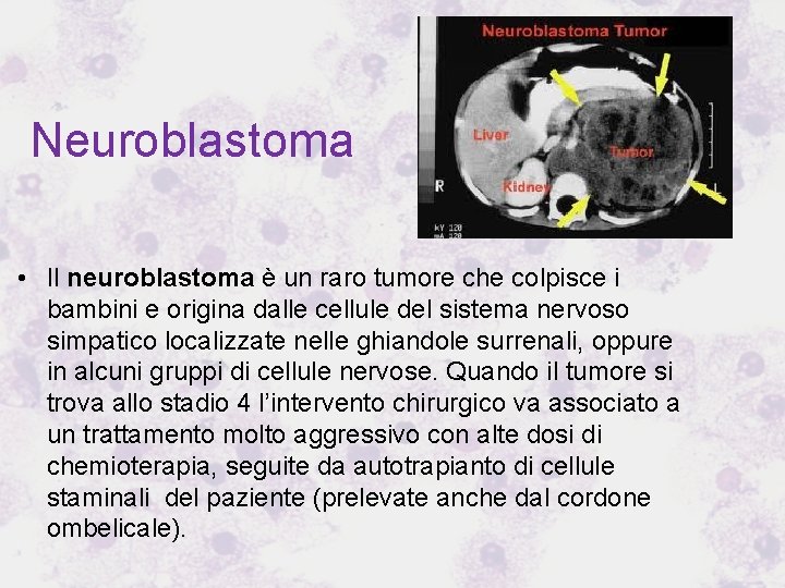 Neuroblastoma • Il neuroblastoma è un raro tumore che colpisce i bambini e origina