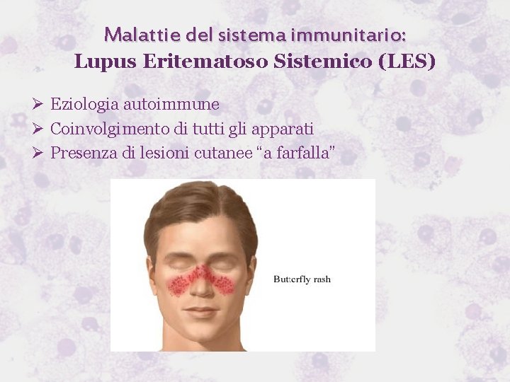 Malattie del sistema immunitario: Lupus Eritematoso Sistemico (LES) Ø Eziologia autoimmune Ø Coinvolgimento di