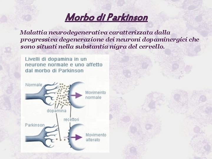 Morbo di Parkinson Malattia neurodegenerativa caratterizzata dalla progressiva degenerazione dei neuroni dopaminergici che sono