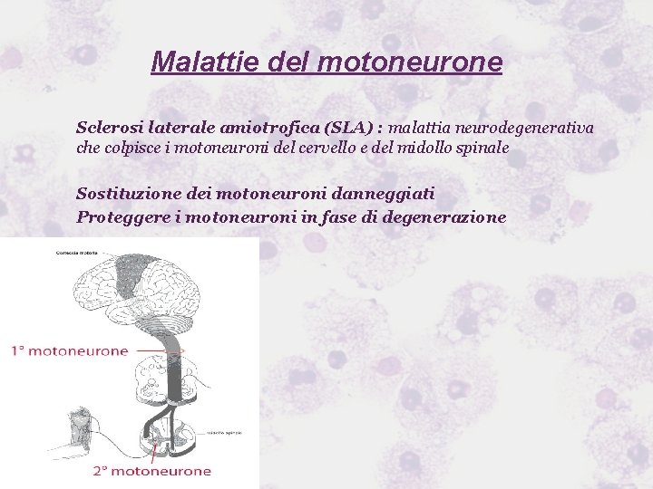 Malattie del motoneurone Sclerosi laterale amiotrofica (SLA) : malattia neurodegenerativa che colpisce i motoneuroni