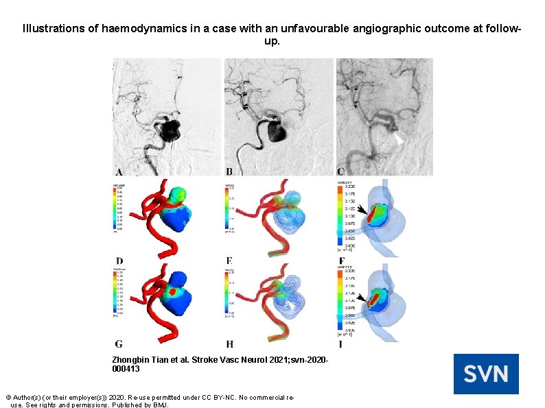 Illustrations of haemodynamics in a case with an unfavourable angiographic outcome at followup. Zhongbin