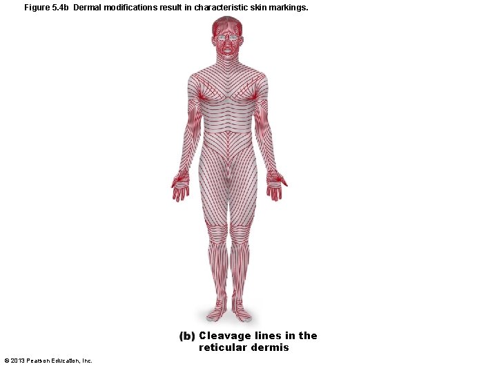 Figure 5. 4 b Dermal modifications result in characteristic skin markings. Cleavage lines in