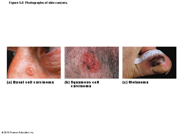 Figure 5. 8 Photographs of skin cancers. Basal cell carcinoma © 2013 Pearson Education,