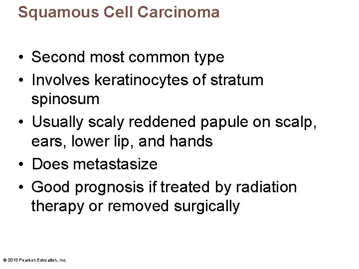 Squamous Cell Carcinoma • Second most common type • Involves keratinocytes of stratum spinosum