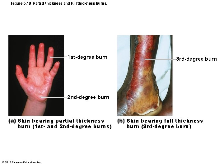 Figure 5. 10 Partial thickness and full thickness burns. 1 st-degree burn 3 rd-degree