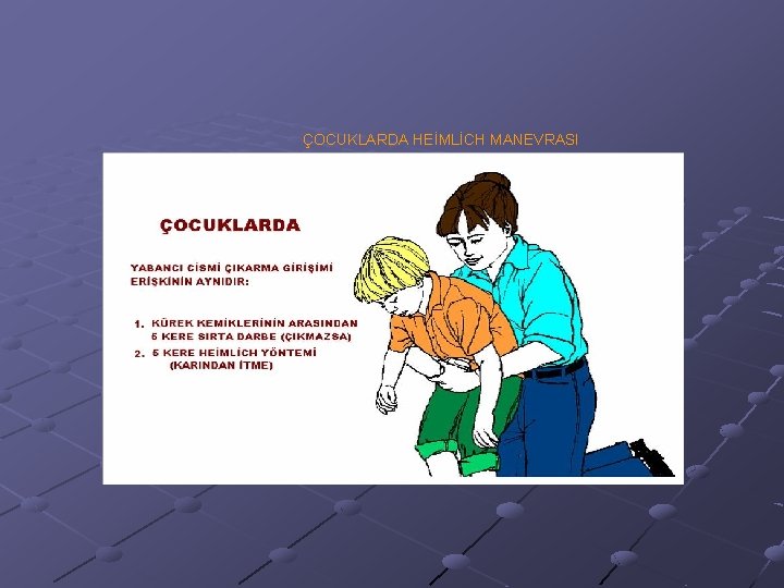 ÇOCUKLARDA HEİMLİCH MANEVRASI 