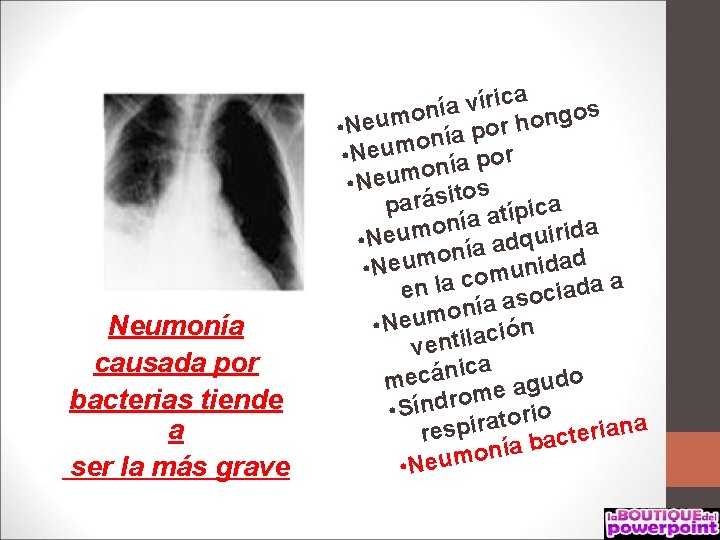 Neumonía causada por bacterias tiende a ser la más grave a c i r