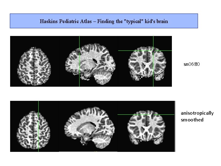 Haskins Pediatric Atlas – Finding the "typical" kid's brain sn 0680 anisotropically smoothed 