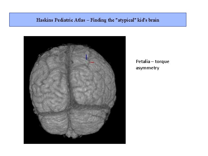 Haskins Pediatric Atlas – Finding the "atypical" kid's brain Petalia – torque asymmetry 