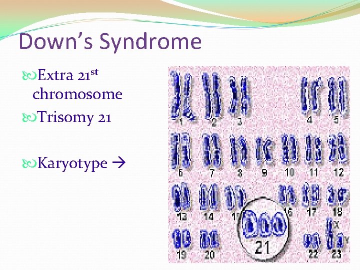 Down’s Syndrome Extra 21 st chromosome Trisomy 21 Karyotype 